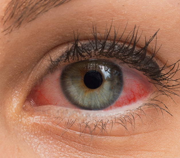 Dry Eyes Treatment after